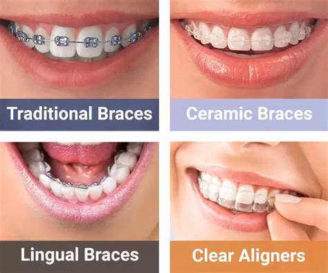 metal and ceramic brackets|types of braces ceramic brackets.